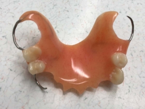 A Partial Upper Acrylic Denture with four artificial teeth and metal clasps to hook onto your natural teeth to hold it in