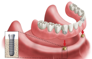 Drawing of an implant retained lower denture, showing locator-type implant posts in the gum that the removable denture snaps onto, with inset diagram of implant in jaw bone