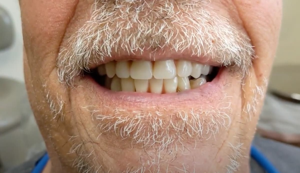 Closeup of a patient showing his new final full upper and partial lower dentures set in wax during the wax try-in appointment