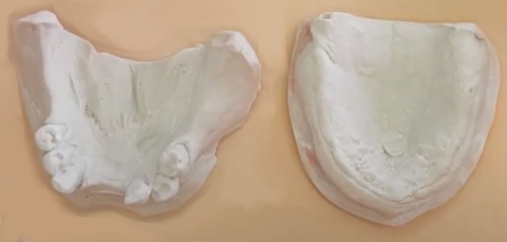 Preliminary plaster denture models of a patient's bottom and top ridges and teeth that were made from the preliminary impressions