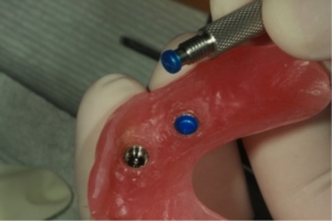 Replacing a blue nylon insert in an implant denture using a special tool
